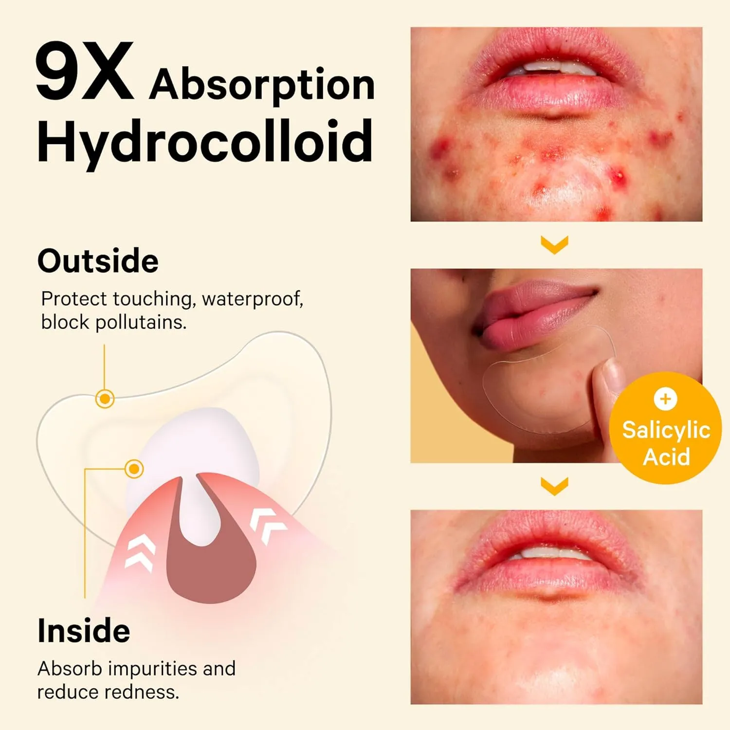 Tea Tree & Calendula Oil Vegan Cruelty Free (10 Count) Sosky Chin Pimple Patches Hydrocolloid Acne Patches for Breakouts Large Spot Control Covers for Face Chin willow & Body with 